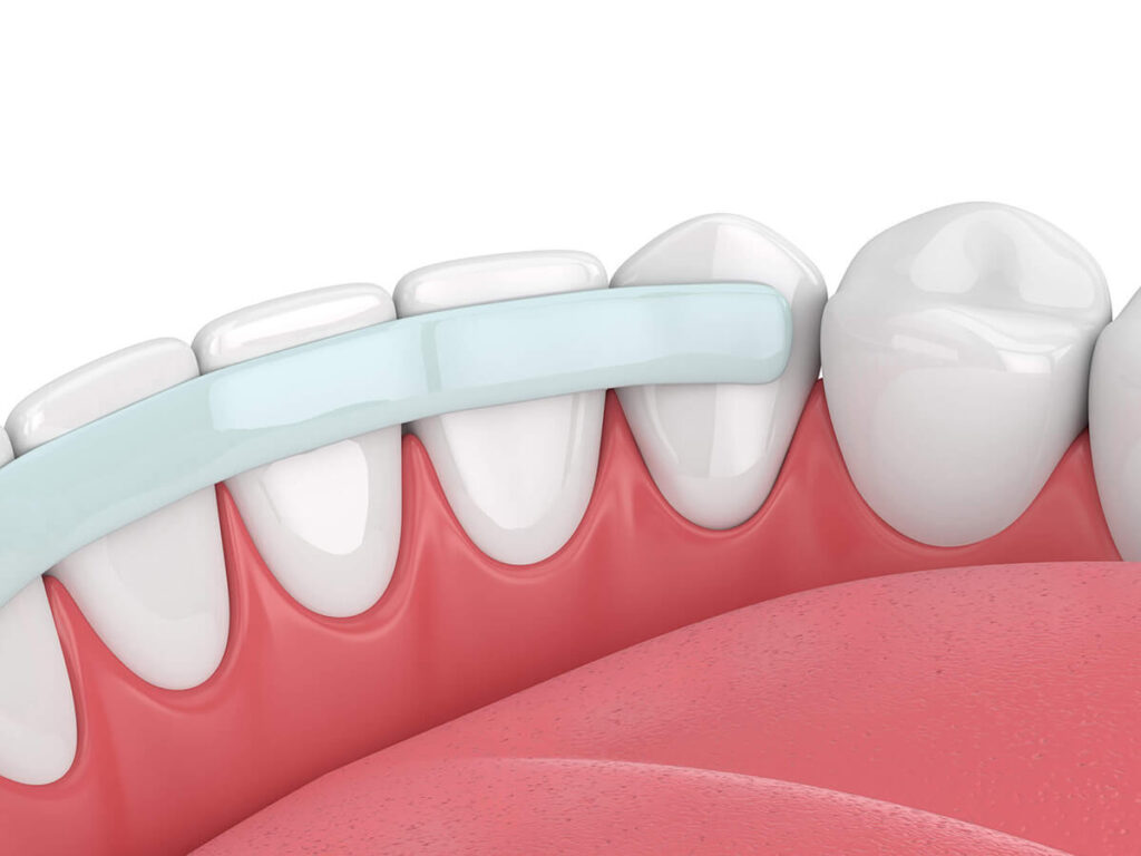 Dental bonding Service
