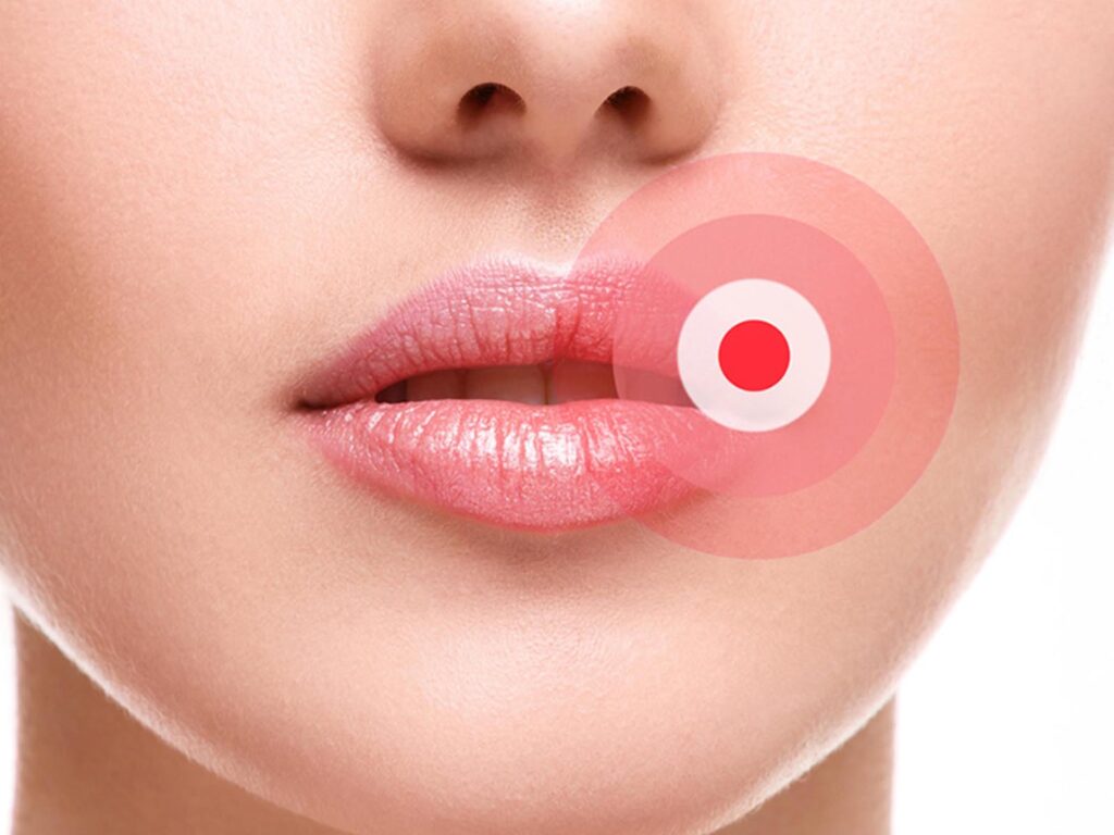 Cold Sore Treatment